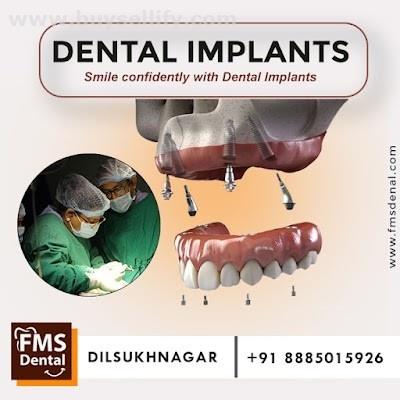 Dental Implants That Bring Back Your Smile for Life |FMS DENTAL CLINIC -Dilsukhnagar