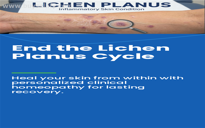 Homeopathy Treatment For Lichen Plannus -Aura Homeopathy india
