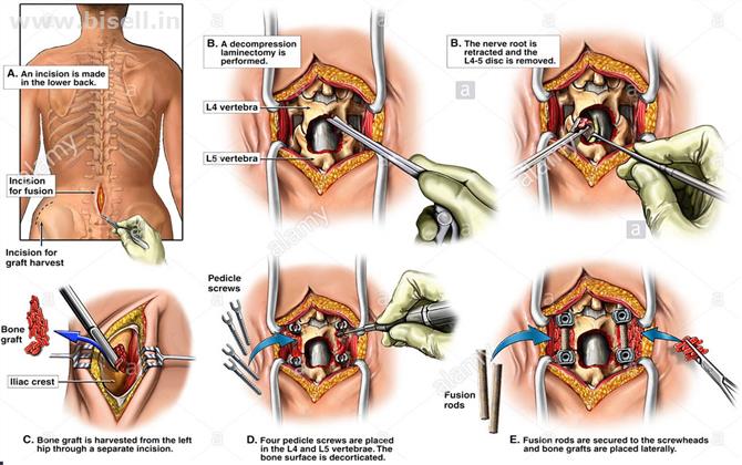 Laminectomy and Discectomy of Spine Surgery in Delhi